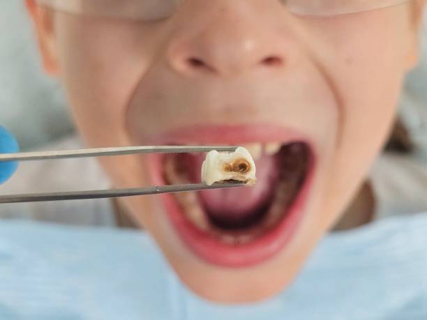 Best Emergency Broken Tooth Repair in Avodo Heights, CA